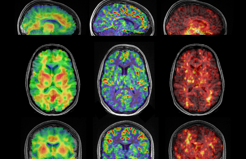A graphic shows examples of brain imaging from different angles. Bright colors show the varying levels of stiffness or softness in the brain.