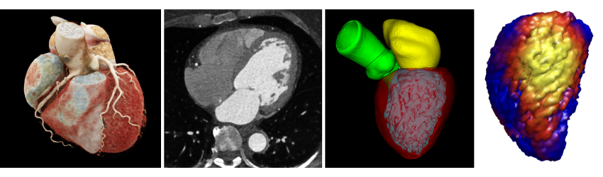 Collage showing the process of a personalized computational modeling pipeline for the heart.