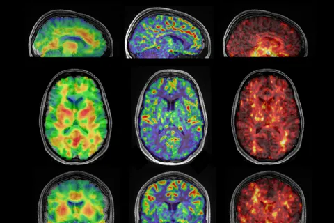 A graphic shows examples of brain imaging from different angles. Bright colors show the varying levels of stiffness or softness in the brain.