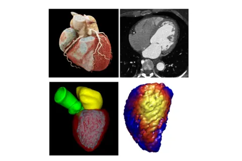 Collage showing the process of a computational modeling for the heart.